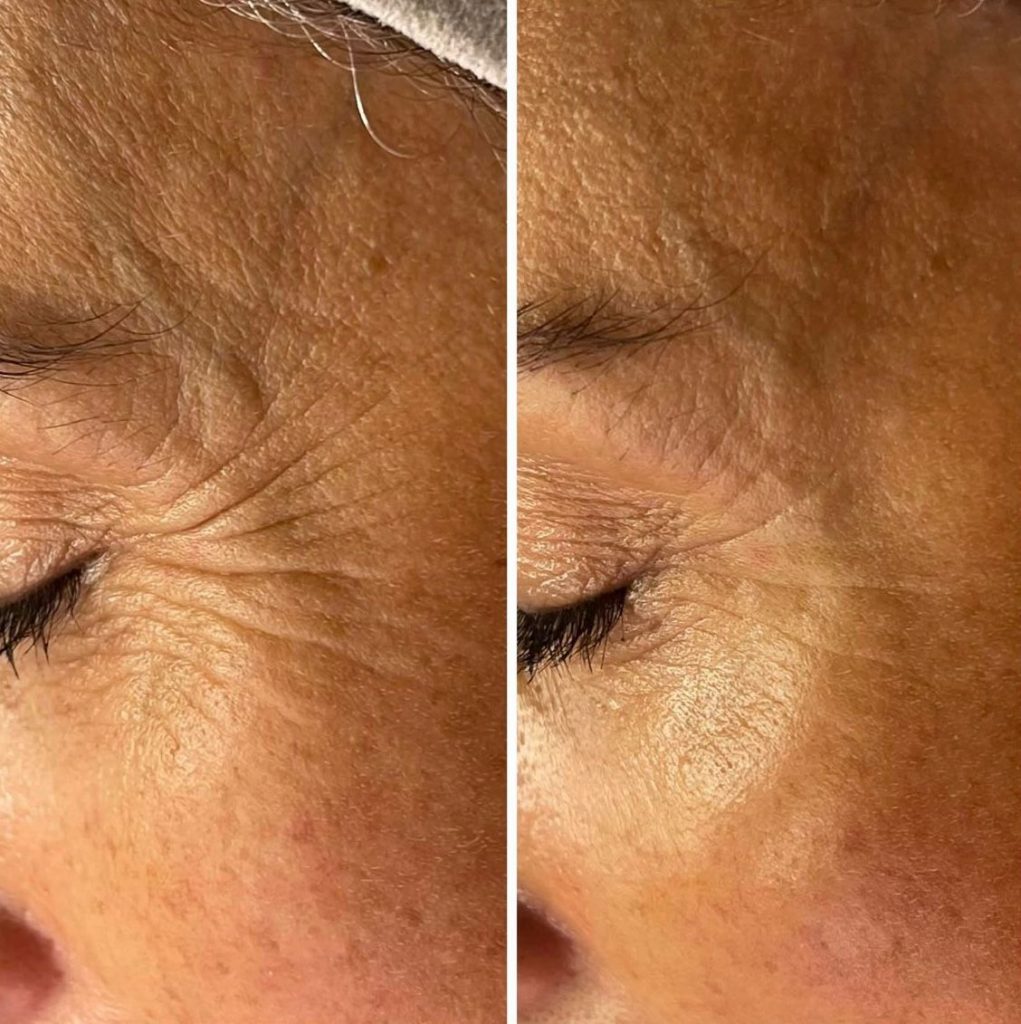 résultat soin anti-age jadea